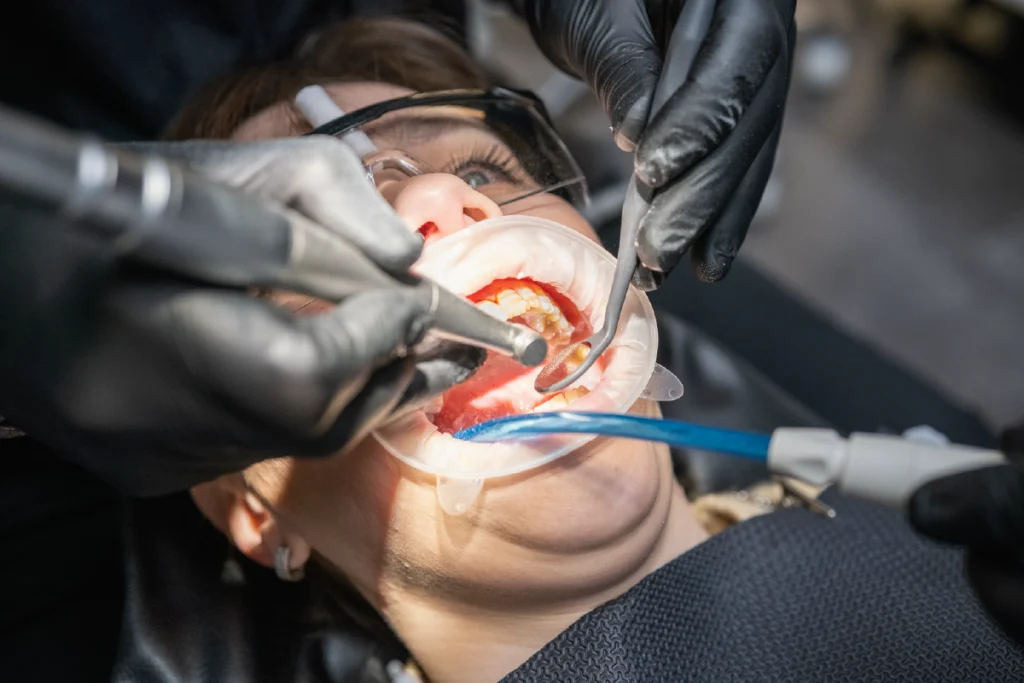 Dentist using a dental handpiece to cut a zirconia crown with water cooling