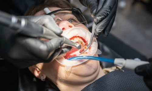 Dentist using a dental handpiece to cut a zirconia crown with water cooling